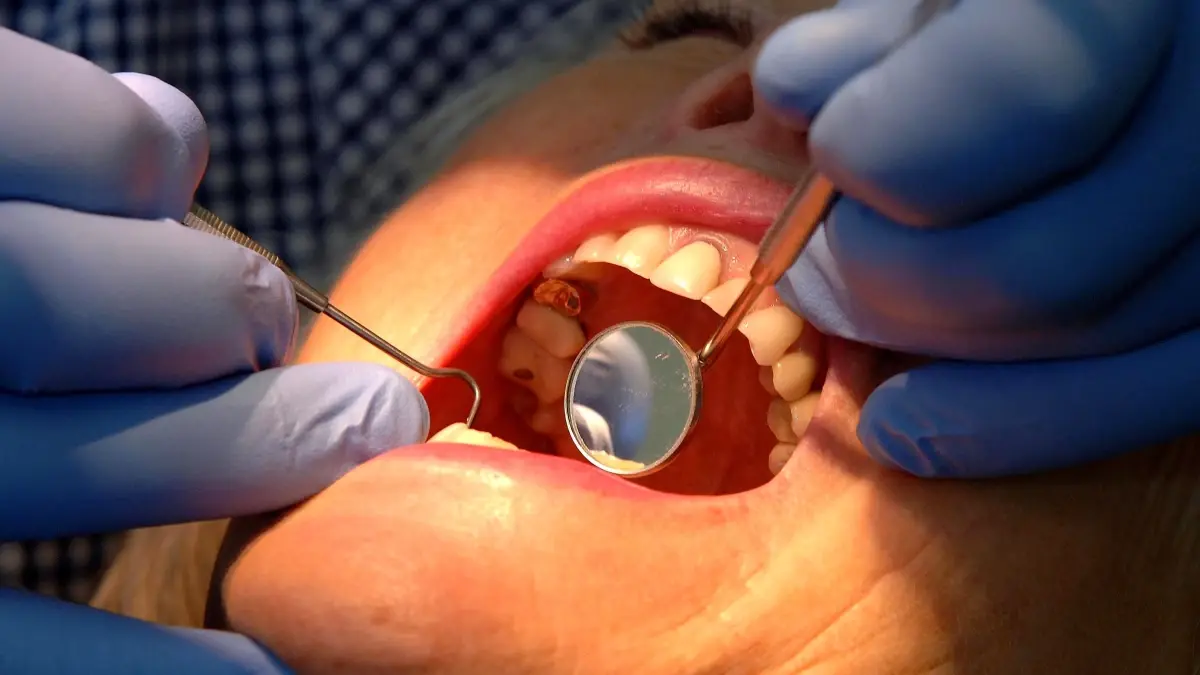 nottingham universitesinden dis minesini yenileyen yeni jel gelistirildi MIjW1Qrk.jpg